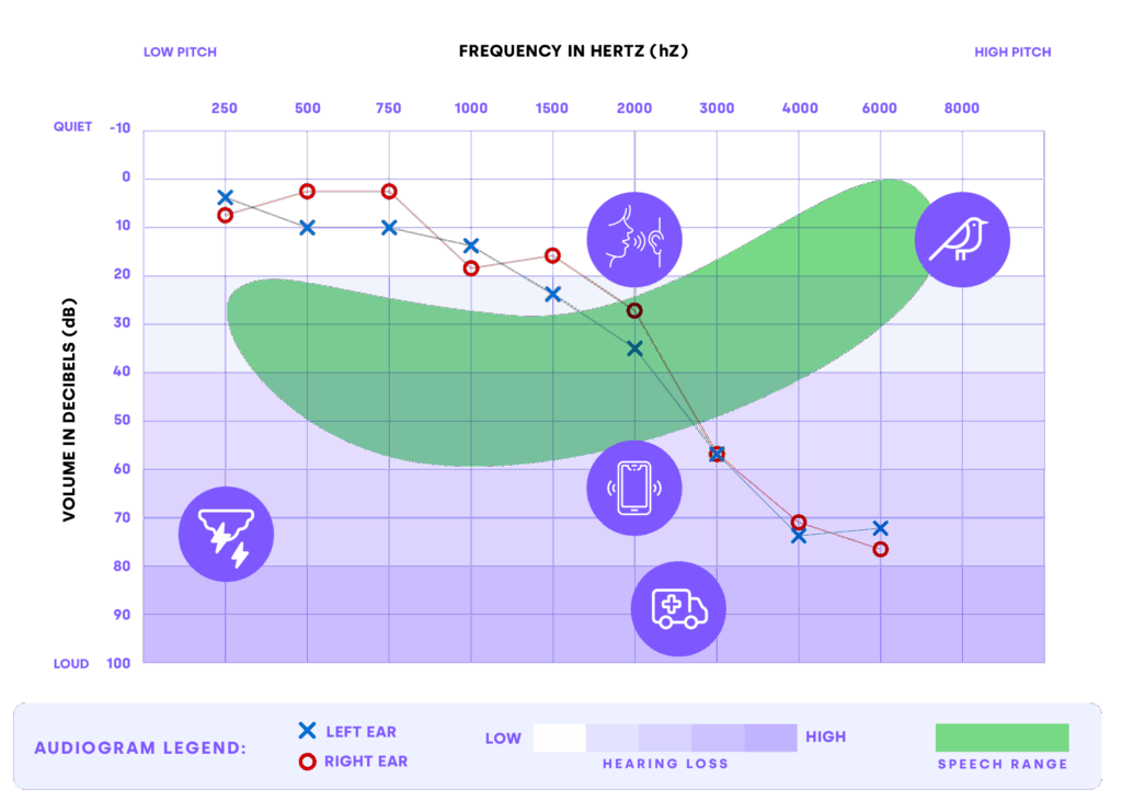 Audiogram example showing high-frequency hearing loss with speech range highlighted.
